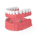 Tewksbury, MA, Renew Dental denture & implant center