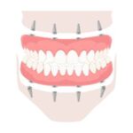 implant dentures Tewksbury, MA,