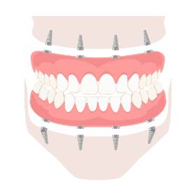 implant dentures Tewksbury, MA,