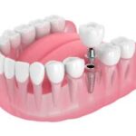 Dental implants Tewksbury, MA, Renew Dental denture & implant center