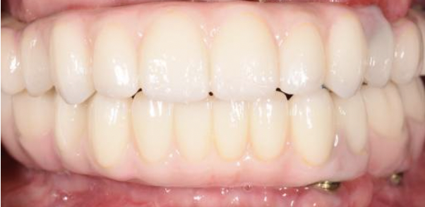 Smile makeover. Dr. Elaine Wu, Tewksbury, MA, implant dentures Tewksbury, MA, sleep apnea Tewksbury, MA