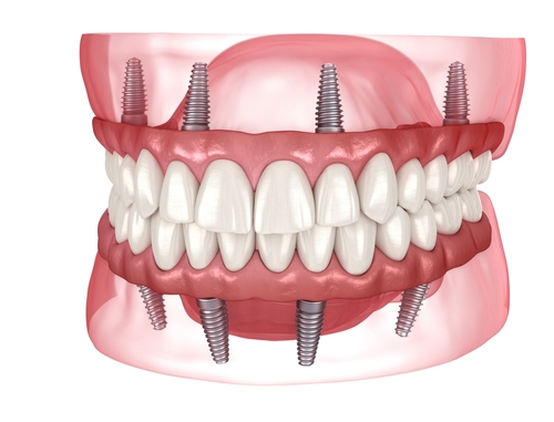 all on 4 Dental implants Tewksbury, MA, Renew Dental denture & implant center