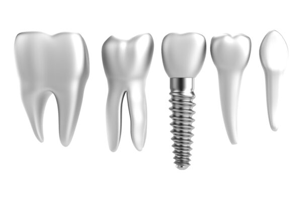 dental implants vs dental bridges Tewksbury MA