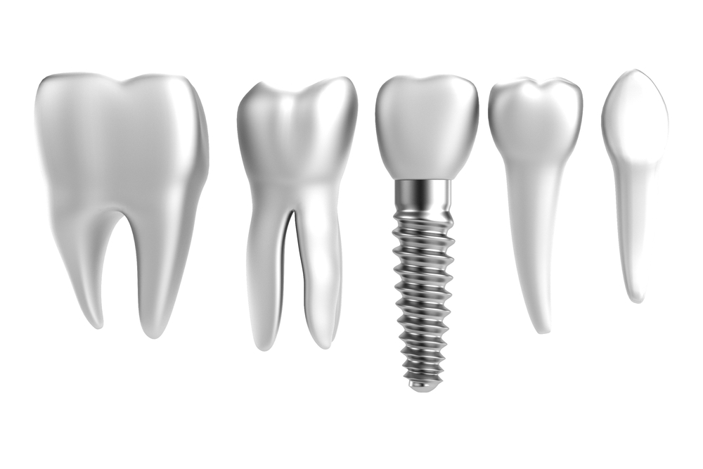 Dental Implants Vs Dental Bridge Tewksbury MA