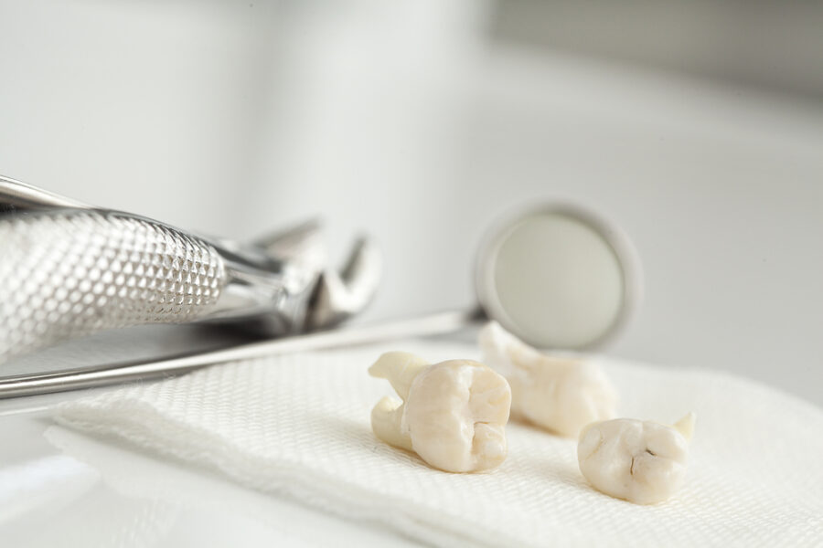 wisdom teeth removal tewksbury ma