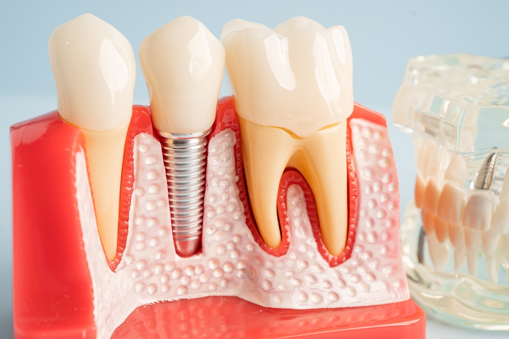 cost of dental implants