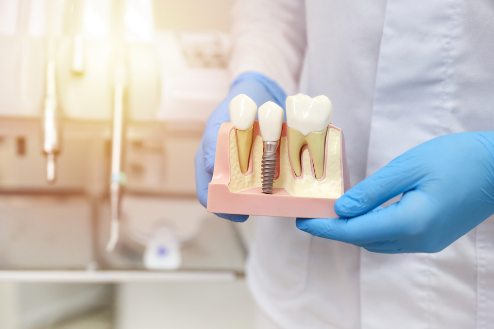 Why a Dental Implant Dentist is Your Smile’s Best Friend