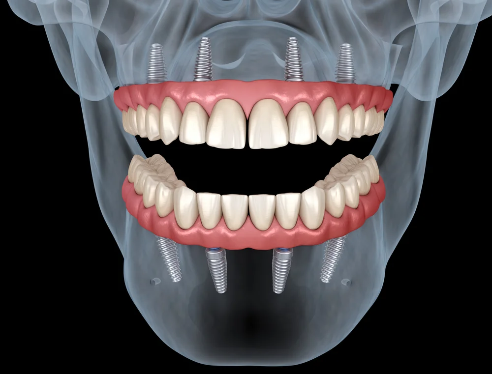 dental implants and dentures