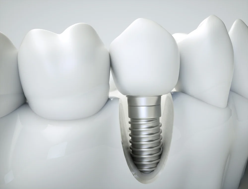 dental implants and dentures