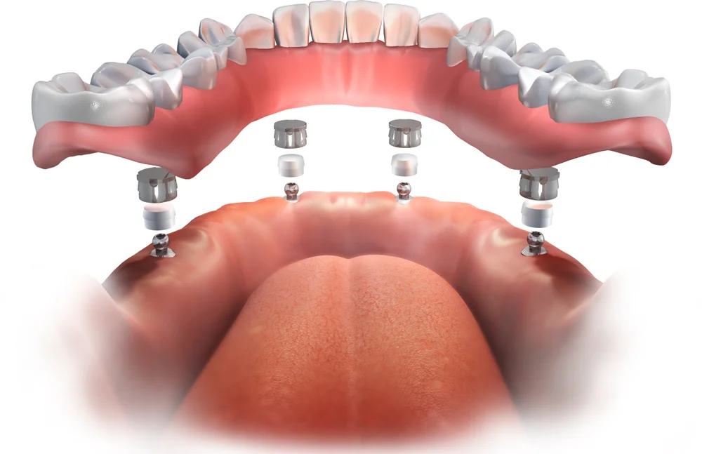 dental implants and dentures