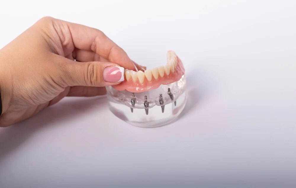 dental implants and dentures