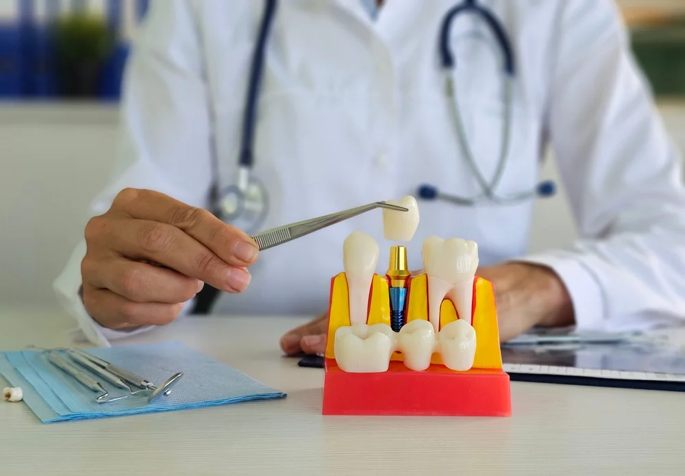 Unlocking the Full Benefits of Dental Implants in Tewksbury MA