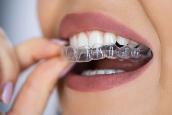 Traveling with clear aligners: How to Stay on Track During Your Adventures